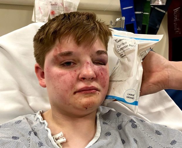 Kady Grass provided this photo taken at Advocate Sherman Hospital in Elgin to show the injuries she received in a May 13, 2025, fight with two teens who allegedly used a gay slur and attacked her while at a Carpentersville McDonald's. (Kady Grass)